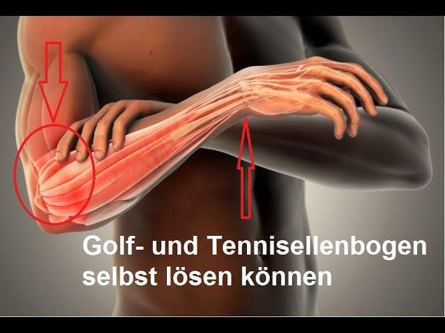 schnelle Selbsthilfe bei Golferarm & Tennisellenbogen - Epicondylitis