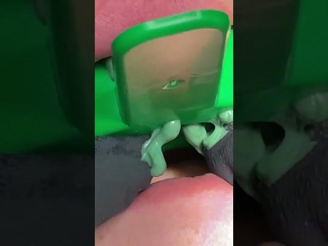 For two veneers!