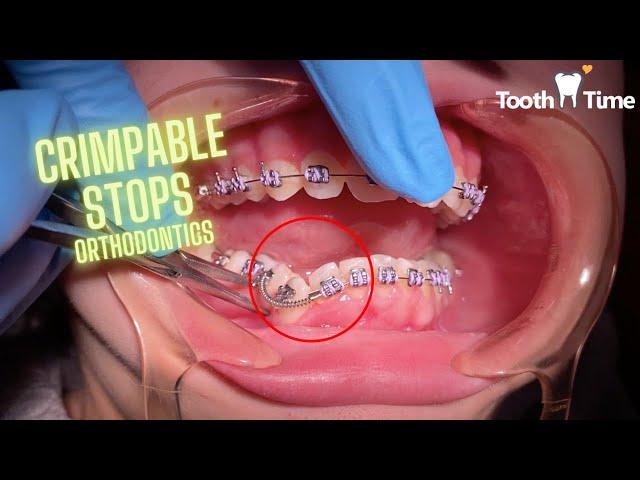 Braces on - crimp stop application - coil springs - Tooth Time Family Dentistry New Braunfels