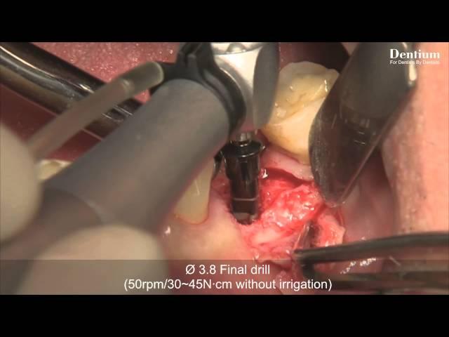 Dentium SimpleLine ll system on #36 area