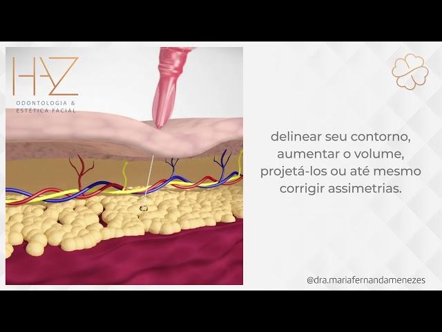 PREENCHIMENTO LABIAL - HARMONIZAÇÃO OROFACIAL - DRA MARIA FERNANDA MENEZES