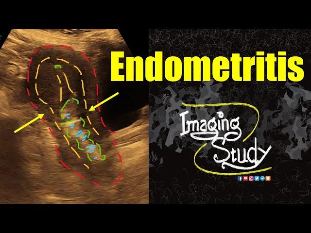 Endometritis || Ultrasound || Case 354