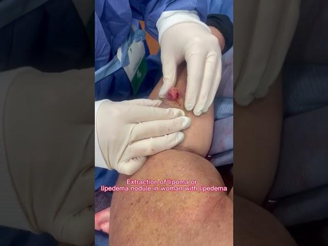 Extraction of lipoma or  lipedema nodule in woman with lipedema