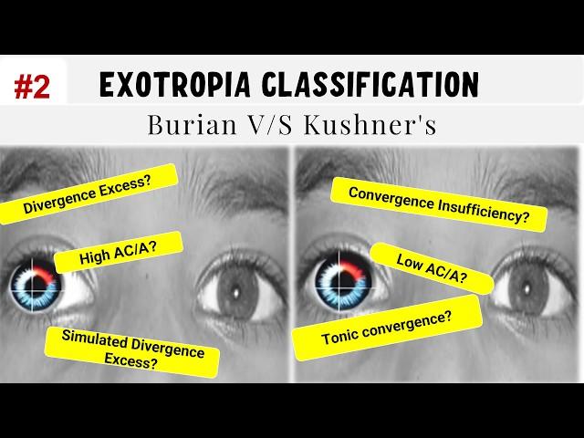 Classification of Exotropia | All you need to know