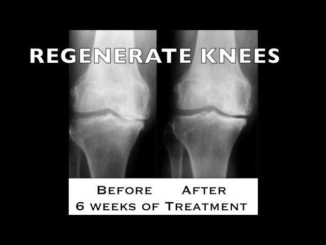 REGENERATE YOUR KNEES (no surgery needed) #18 | https://drstephenstokes.com