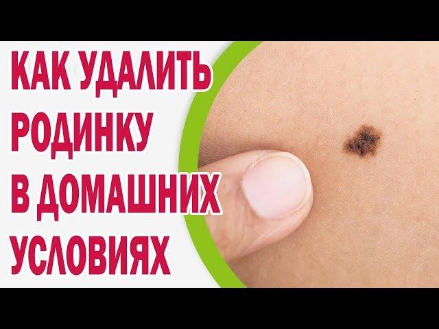 Как удалить родинку в домашних условиях