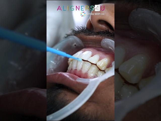 Get Perfect Smile Makeover  With Best Clear Aligners Treatment In Hyderabad | Aligners4u | Braces