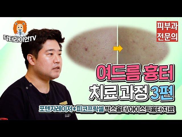포텐자레이저+피코프락셀 박스흉터/송곳모양/패인흉터 치료과정 3편