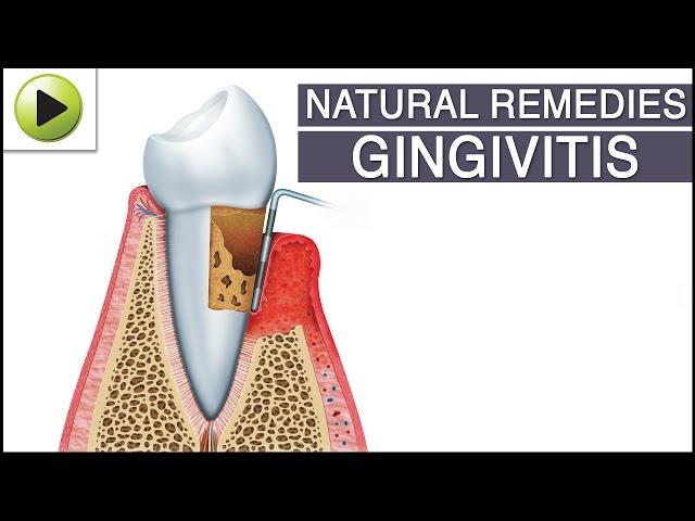 Gingivitis - Natural Ayurvedic Home Remedies