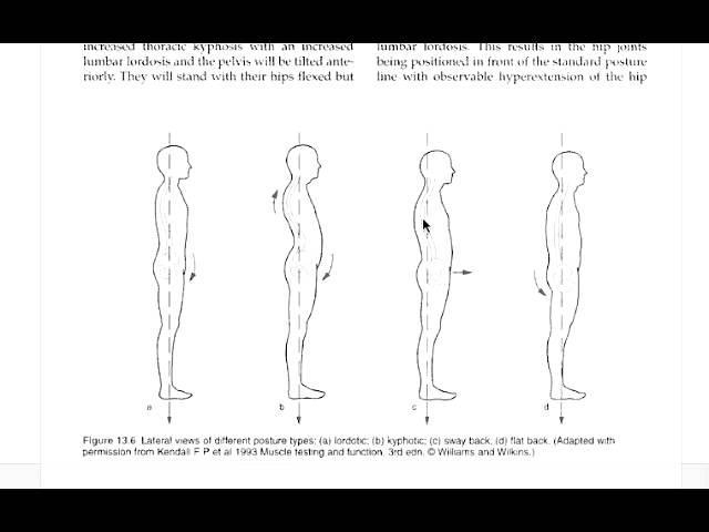 How to Correct Swayback Posture