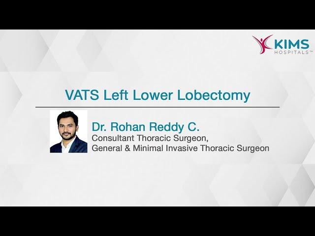 VATS Left Lower Lobectomy | Insidious Dry Cough | Video-assisted Thoracic Surgery | KIMS Hospitals