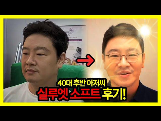 40대 후반 남자가 10살 어려지는 실루엣소프트 리얼 후기 [팔자주름 주름개선 처짐개선 동안 안티에이징]