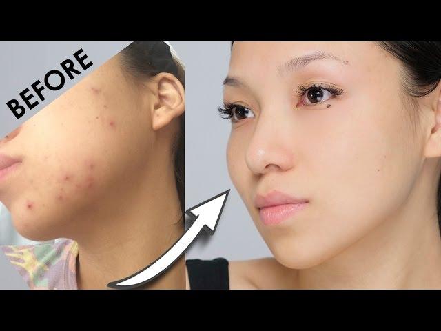 Remove Acne Marks | 3 Home Remedies (100% Works) With Results