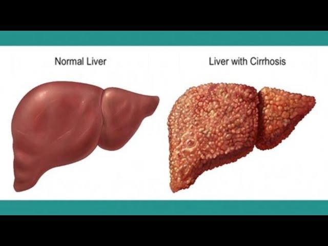 Living With Cirrhosis