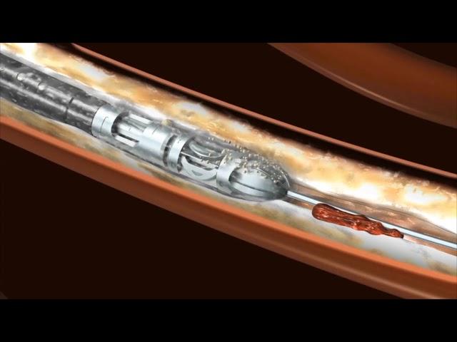 Atherectomy with Jetstream from Boston Scientific | CardioVisual