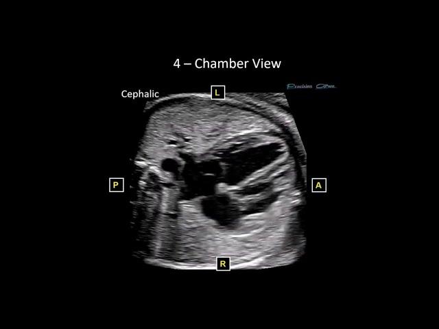 Basic Fetal Echo Protocol and Optimization