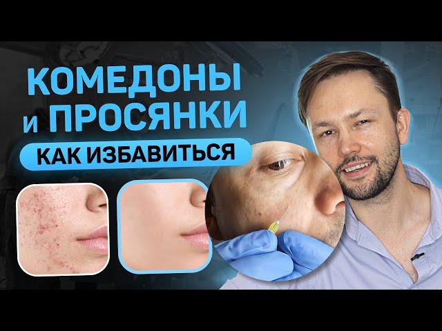 Комедоны и просянки. Удалить без косметолога.