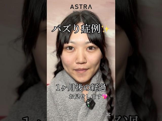 キレイすぎる変化#astrabeautyclinic  #アストラビューティークリニック #塩満恵子 #鼻整形 #美容整形 #忘れ鼻