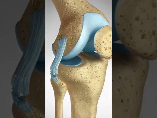 See how an ACL LCL Tear is repaired