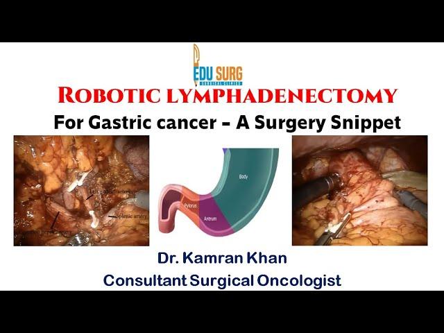 Robotic D2 lymphadenectomy for Gastric cancer - A surgery Snippet - Edusurg Clinics