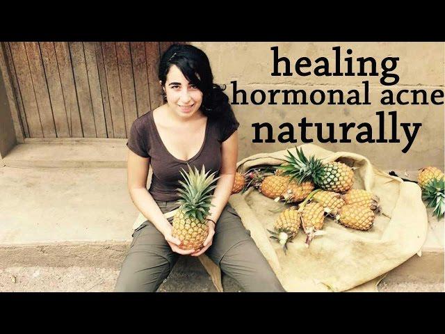 healing hormonal acne | holisticmaya