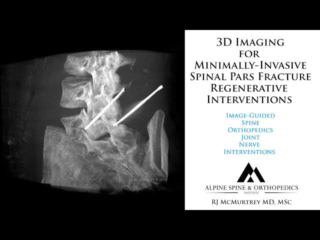 Pars Fracture Defects: New Minimally-Invasive Regenerative Treatment Interventions with 3D Guidance