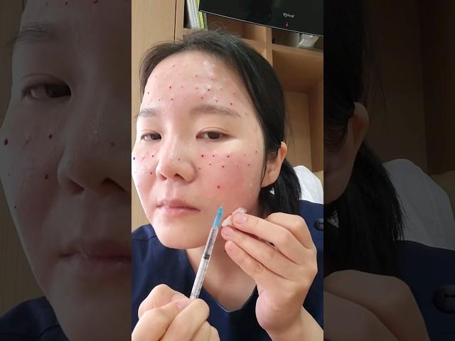 #스킨보톡스 #더모톡신 #메조톡신 #셀프시술 #리얼후기 #효과 #주기 #유지기간 #시술방법 #쁘띠시술 #이마보톡스 #미간보톡스