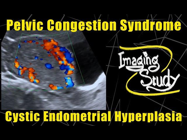 Pelvic Congestion Syndrome & Endometrial Cystic Hyperplasia || Ultrasound || Doppler || Case 90