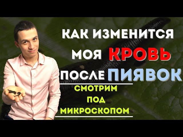 Как ставить пиявки в домашних условиях!? Польза «Гирудотерапии»