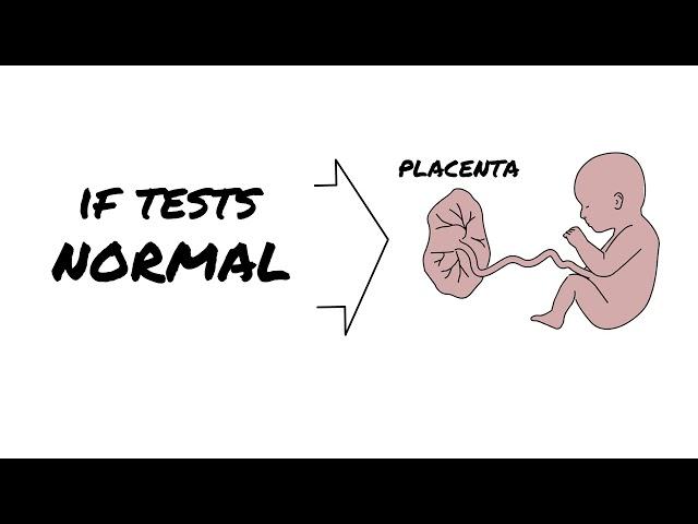 Neonate (newborn) Strokes | AboutKidsHealth at The Hospital for Sick Children