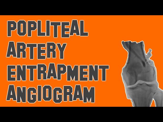 Popliteal Artery Entrapment