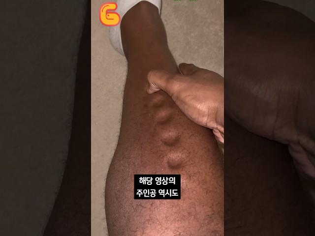몸이 찰흙처럼 변하는 병
