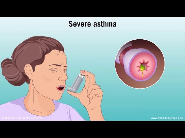 Understanding Asthma: Mild, Moderate, and Severe