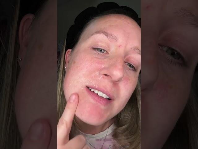 Global #exfoliation #SkinCareRoutine #TikTokMadeMeBuyIt #GlowUp #ViralBeauty #acneskincare