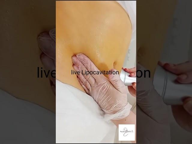 Lipocavitation, solution d'amincissement sans chirurgie