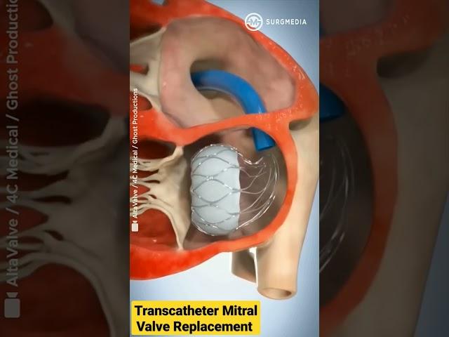 Altavalve: Transcatheter Mitral Valve Replacement (TMVR) #shorts #medical #animation