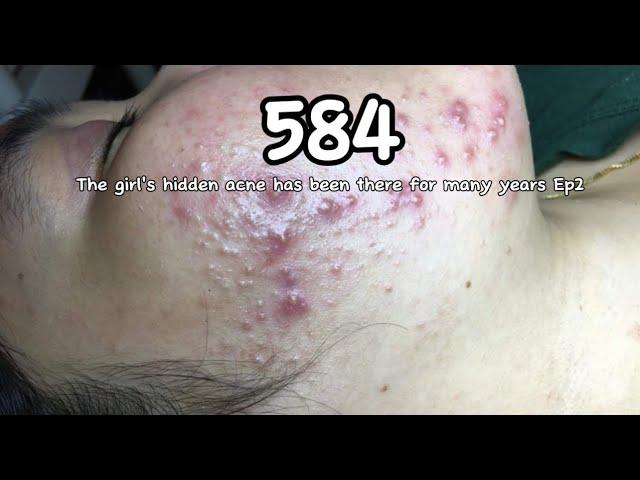 |584| The girl's hidden acne has been there for many years Ep2