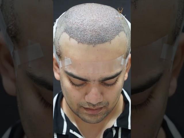 Hair Restoration Results Post 10 Days of Hair Transplant Treatment | Hair Transplant in Ahmedabad