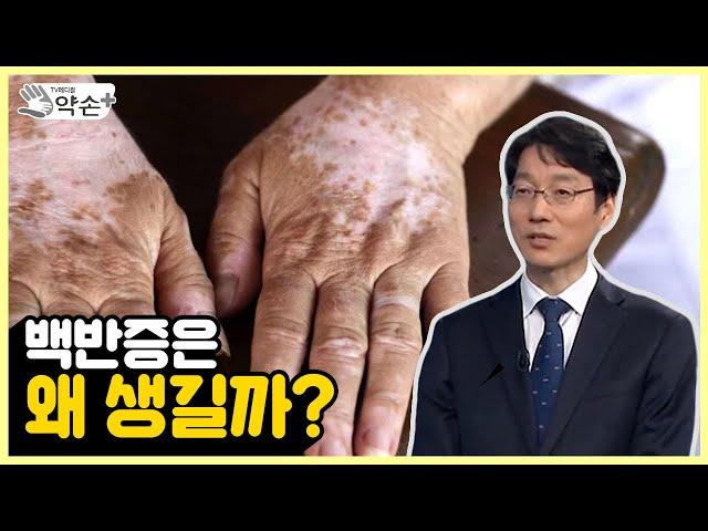 백반증은 왜 생길까? [피부의 흰색 반점? 백반증 제대로 알기 ③] | 메디컬 약손