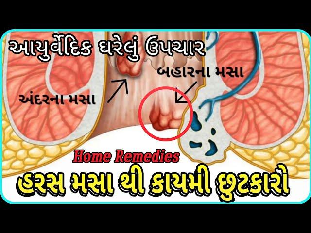 હરસ મસા થી કાયમી છુટકારો | Home Remedies | Gharelu Upchar | Haras masa dur karne ke upay| The Review