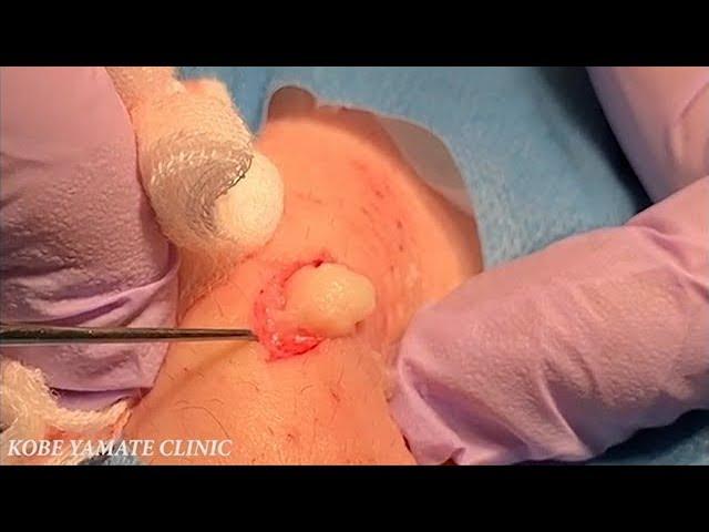 Epidermal cyst removal  - On the back