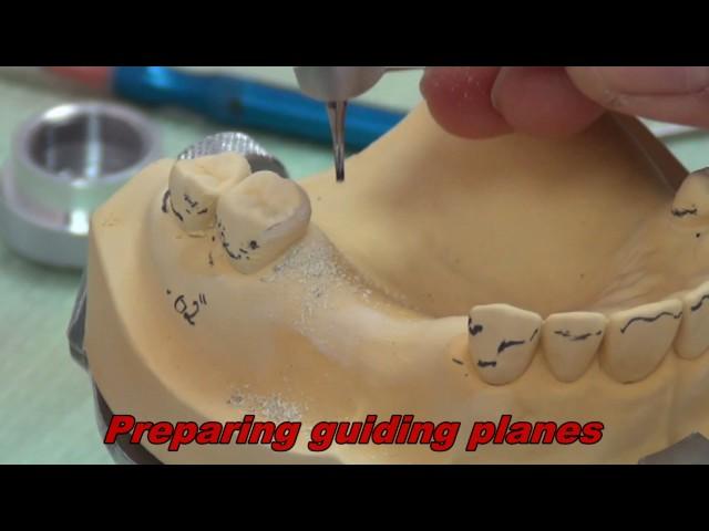 1- Rest Seat Preparation ( for partial denture Construction )