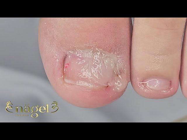  VOCÊ NÃO VAI ACREDITAR ONDE ESTAVA A ESPÍCULA #satisfying #nails