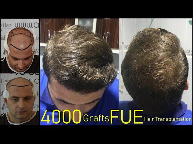 FUE Hair Transplantation Result at Aisha Hair / Resultados FUE Injerto Capilar en la Aisha Hair