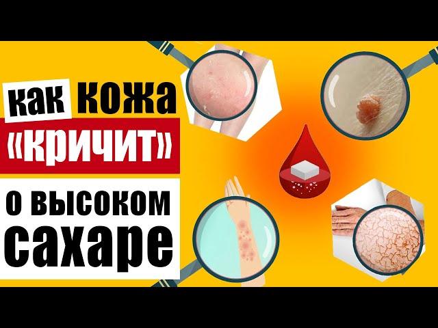 Предупреждающие признаки на коже, которые говорят о высоком уровне сахара в крови