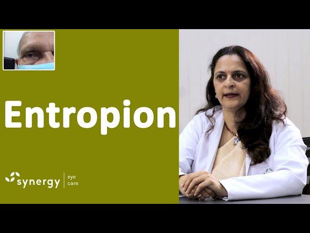 Entropion: What You Should Know? Causes, Symptoms and Treatment