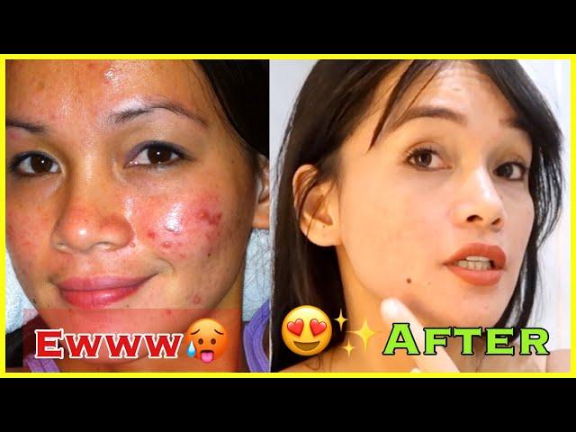 HOW I CLEARED MY ACNE? SKINCARE ROUTINE || PHILIPPINE DERMATOLOGIST || MEDISKIN