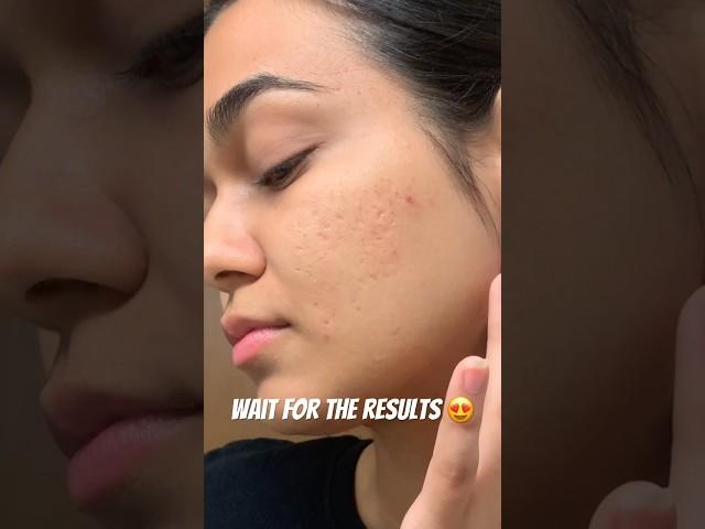 ACNE SCARS TREATMENT #shorts