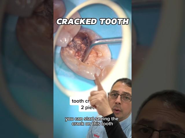 How to Treat a Symptomatic Cracked Tooth | In Office to Hands On Dental Training #shorts