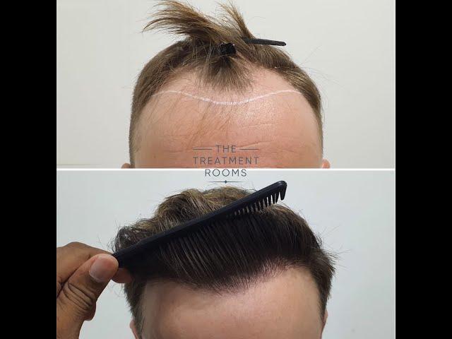 1724 grafts FUE Hair Transplant Result- The Treatment Rooms London, Hair Transplant Clinic